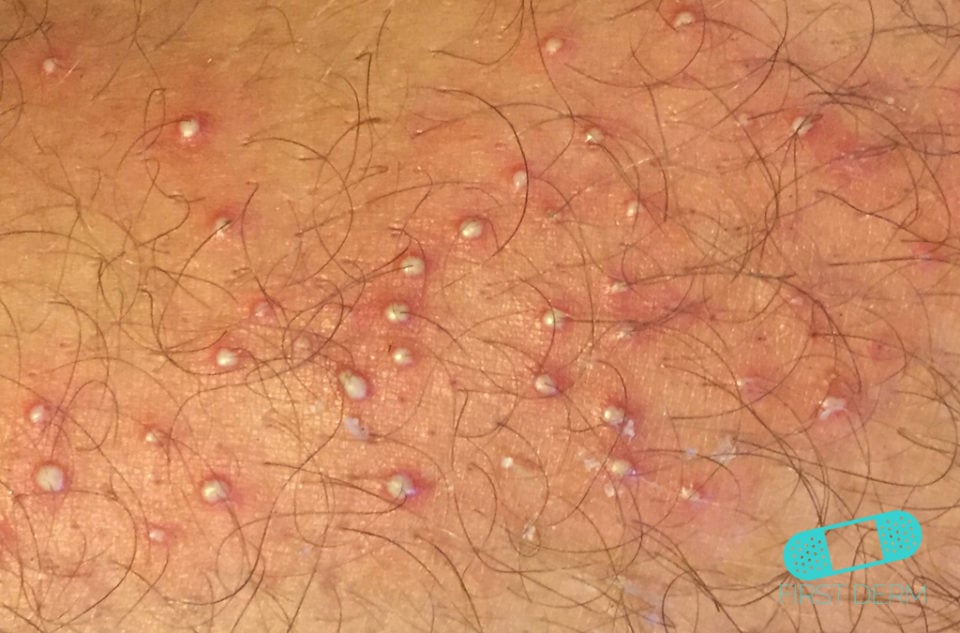 Pubshaving Rash How to Get Rid of Shaving Rashes - Online Dermatology