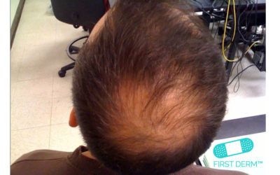 Top Five Causes of male Hair Loss