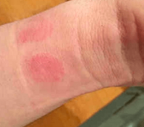 Apple Watch-utslag och din hud | Allergi eller infektion?
