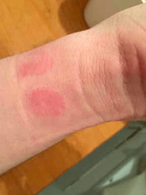 Erupción por Apple Watch y su piel | ¿Alergia o infección?