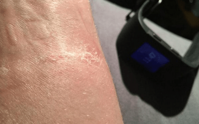 Sarpullidos por Fitbit: ¿Alergia o Dermatitis de contacto?