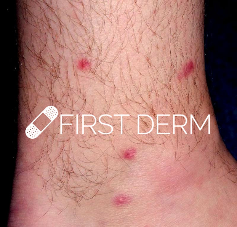 Red Itchy Bumps on Legs | Med-Health.net