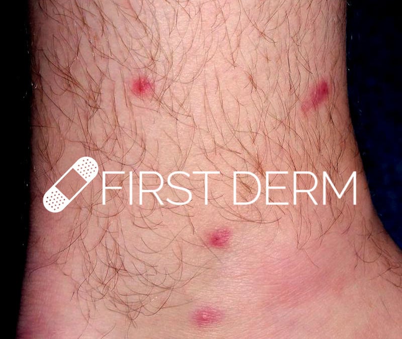Itchy Red Bumps on Skin – Potential Causes