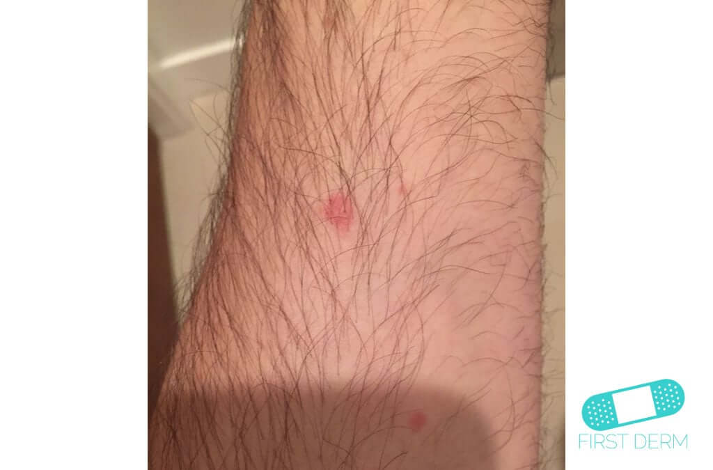 Online Dermatology Nummular Eczema (Discoid Dermatitis)