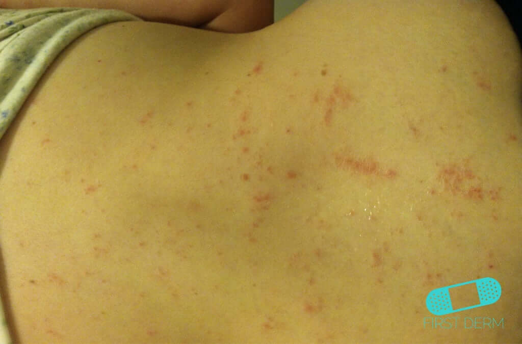 online-dermatology-nummular-eczema-discoid-dermatitis