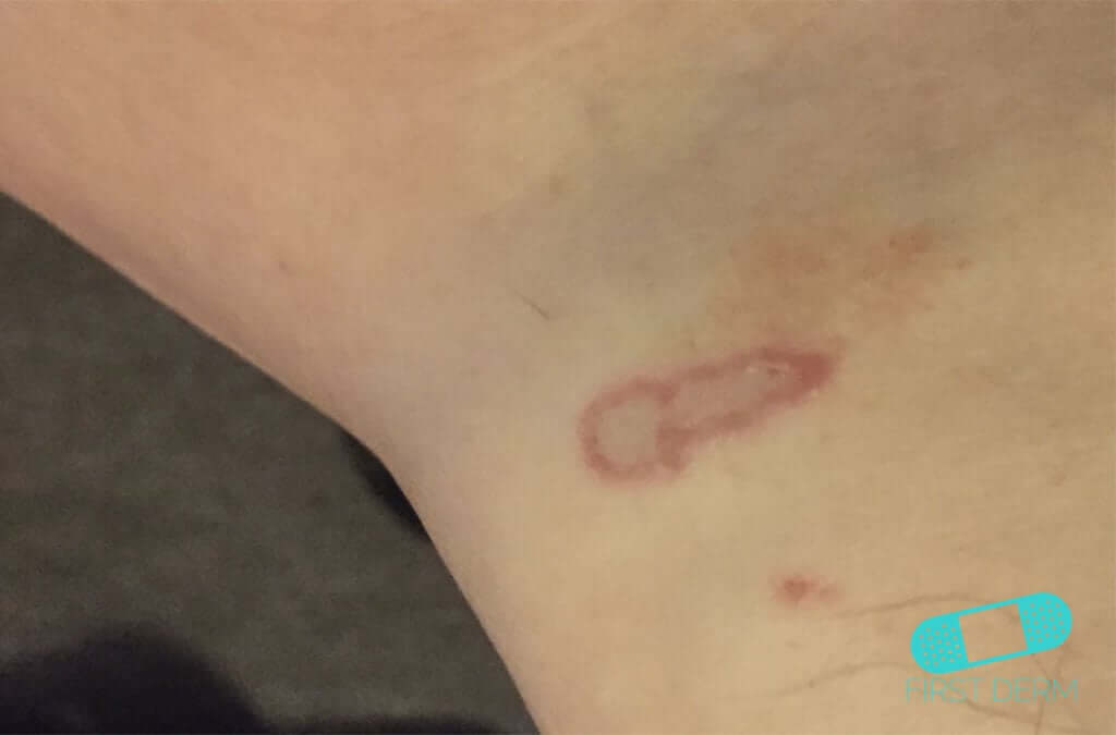 Online Dermatology Nummular Eczema (Discoid Dermatitis)