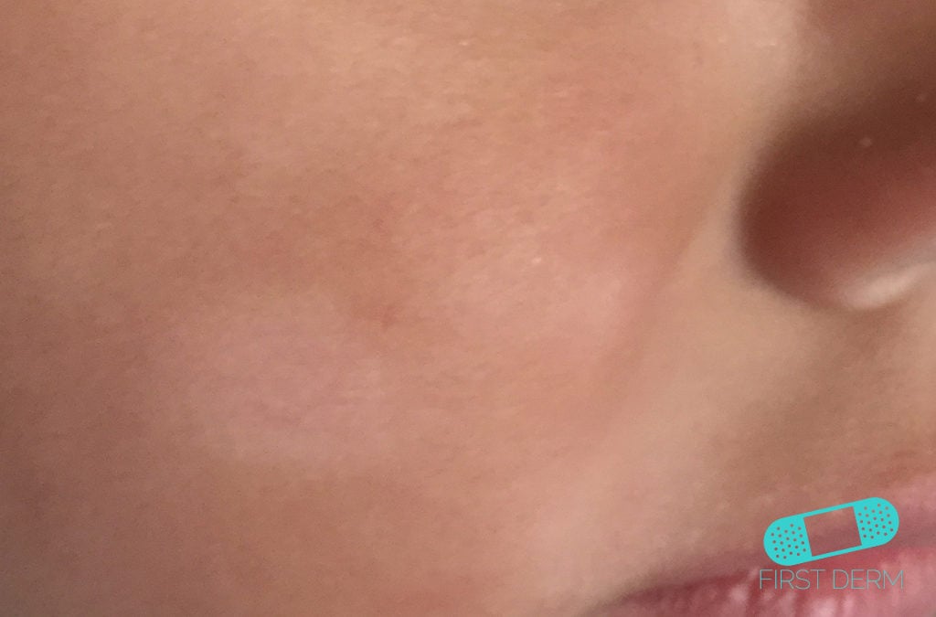 Pityriasis alba