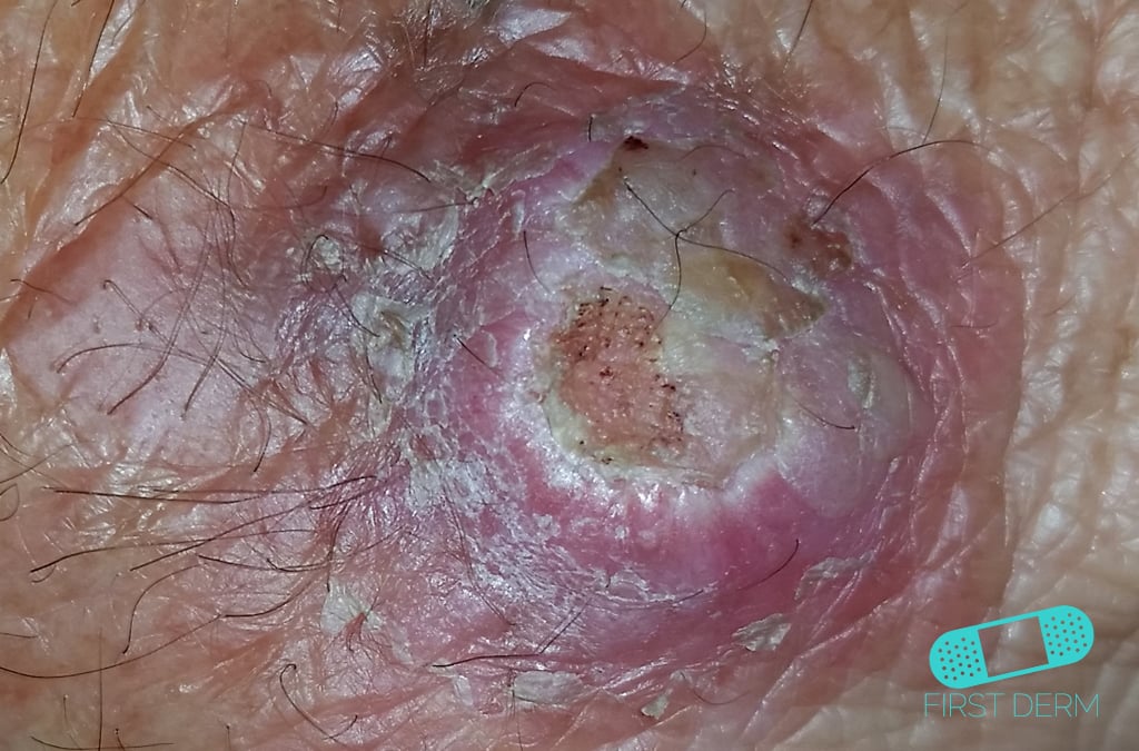 Squamous Cell Carcinoma Pictures, Images & Photos ...