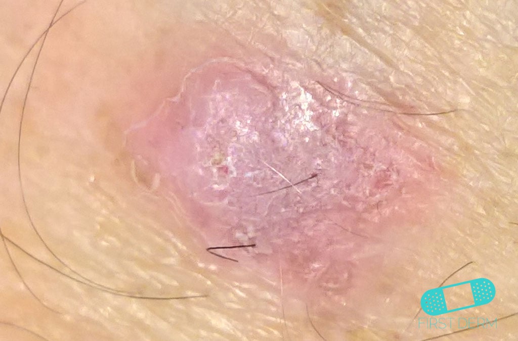 Squamous Cell Carcinoma 7
