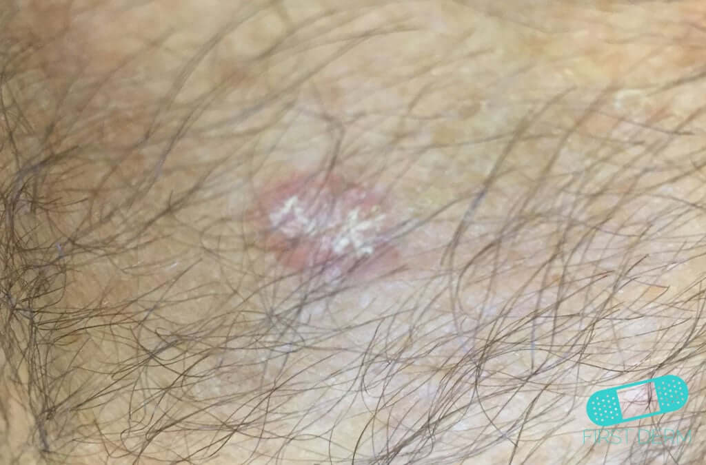 Online Dermatology - Sun-Damaged Skin