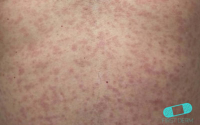 Zikavirus (utslag)