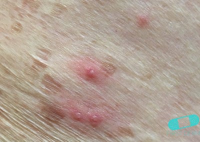 First Derm Herpes Zoster Shingles (13) ICD-10-B02