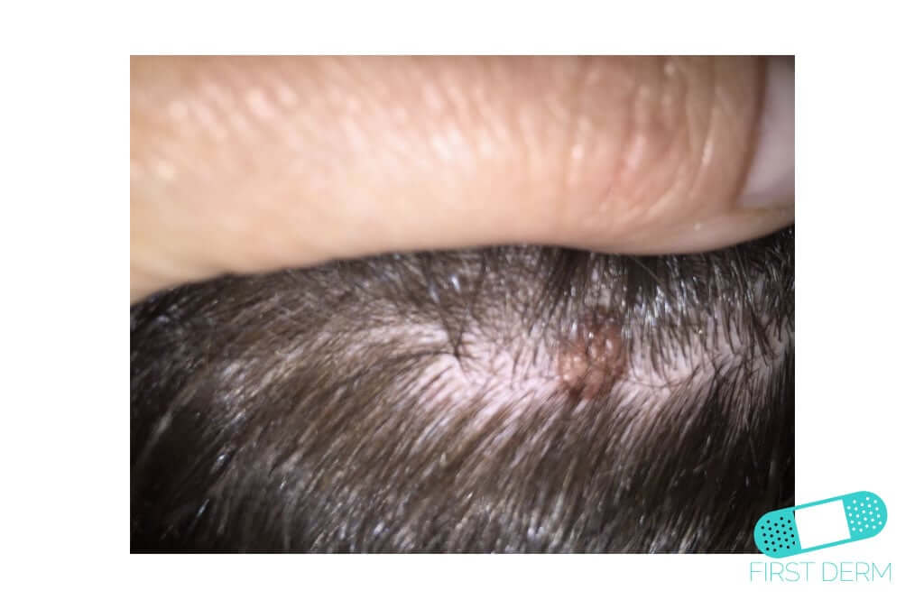online-dermatology-intradermal-nevus