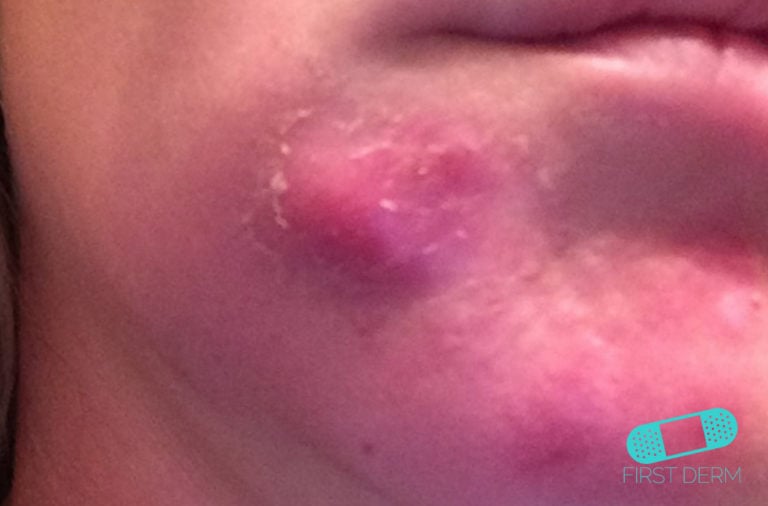 Abscess - Online Dermatology