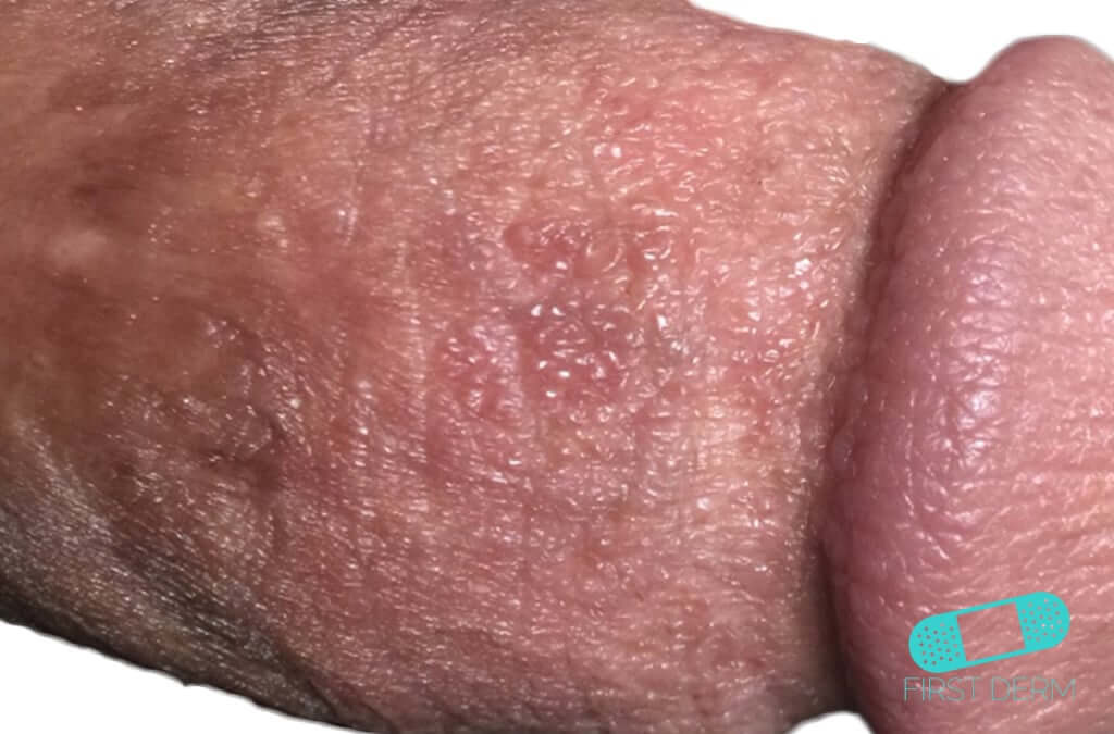 Balanitis (Foreskin Problem)
