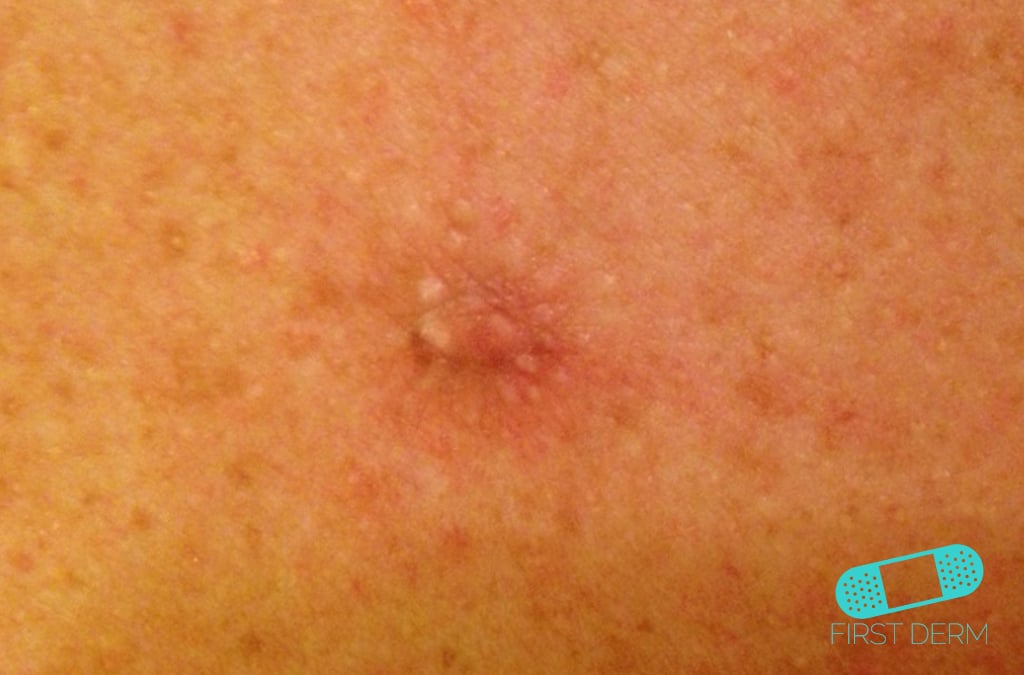 Online Dermatology - Basal cell carcinoma (Basal cell skin ...