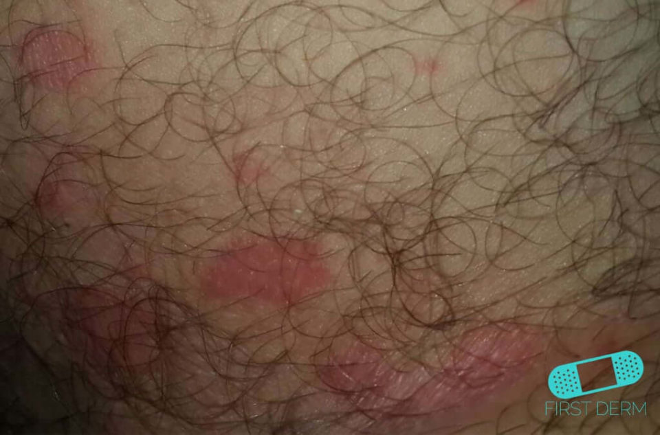Candidiasis (Cutaneous Candidiasis) | First Derm