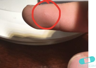 Dyshidrotic eczema (3) ICD-10-L30.1