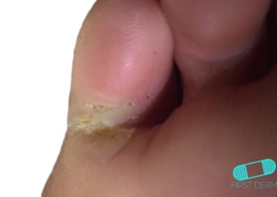 Infección por Hongos (04) dedos [ICD-B35.9]