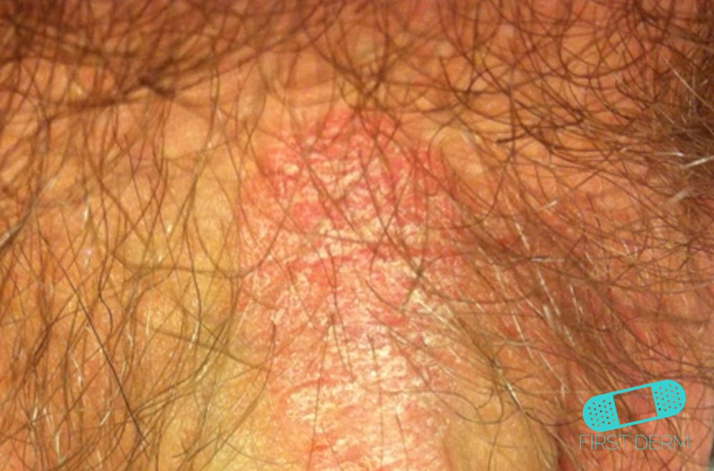 pictures of male genital psoriasis