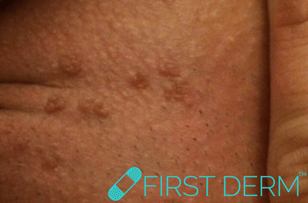 Verrugas Genitales – Virus del Papiloma Humano (VPH)