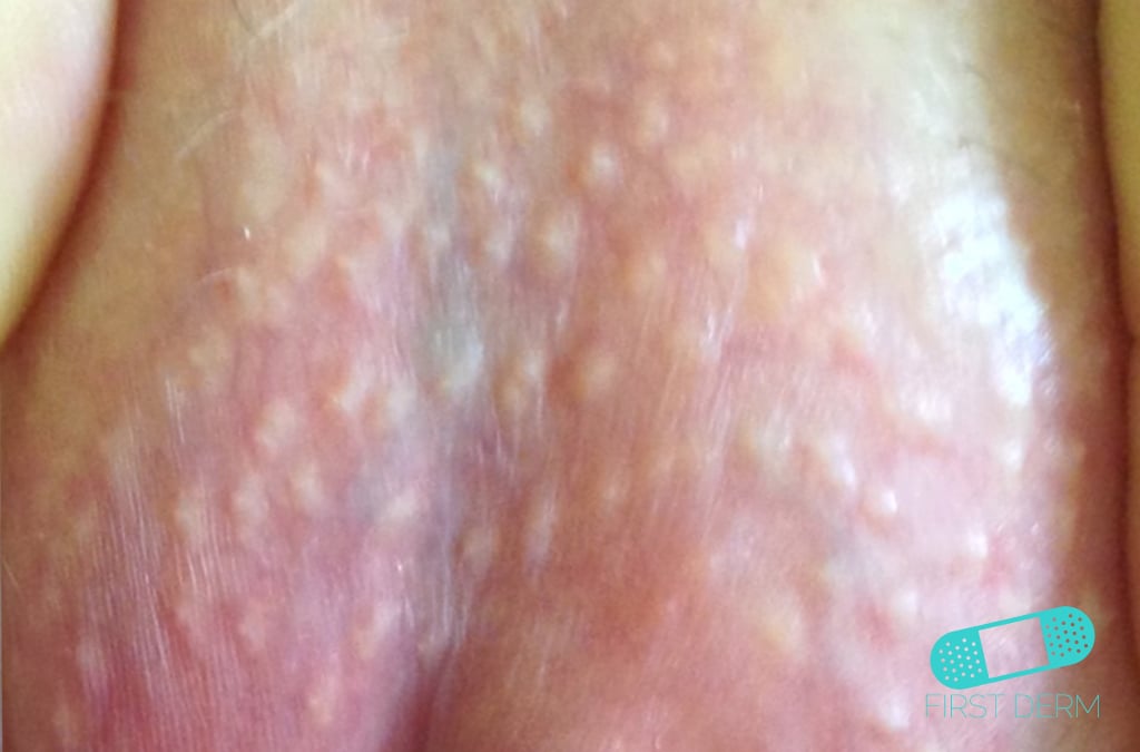 Pictures of Viral Skin Diseases and Problems - Genital ...