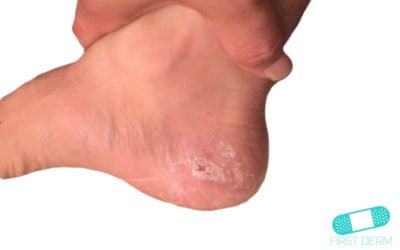 Hiperqueratosis