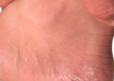 Hyperkeratosis fot (1) ICD-10-A66.3