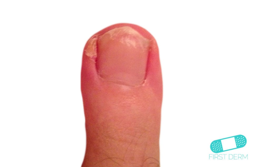 Hyperkeratosis finger (2) ICD-10-A66.3