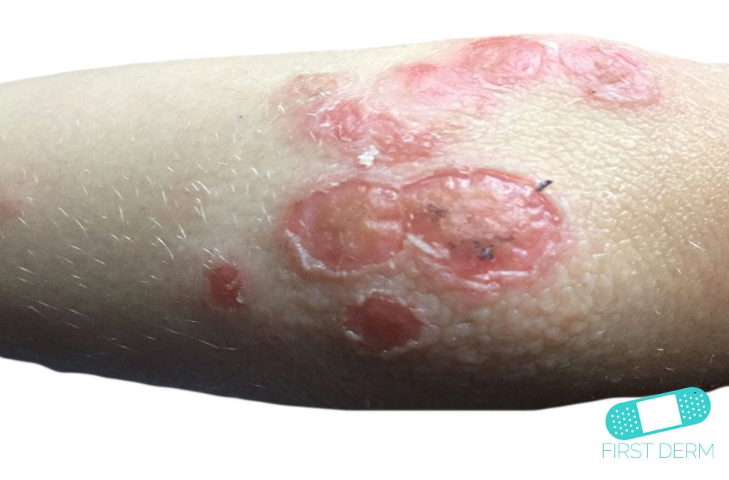 Impetigo in Adults: Condition, Treatments, and Pictures ...