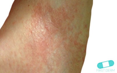 Eccema Irritativo (Dermatitis de Contacto Irritativa)