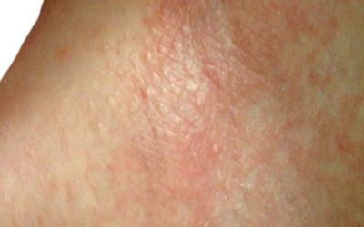 Irritative Eczema (Irritant Contact Dermatitis)