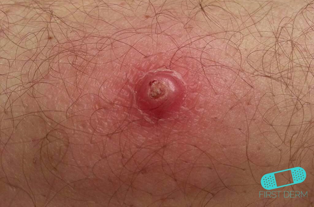 Keratoacanthoma