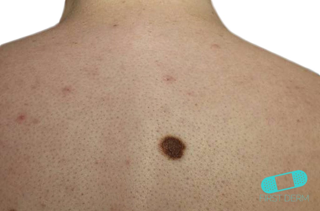 Lunares (nevus congénito)