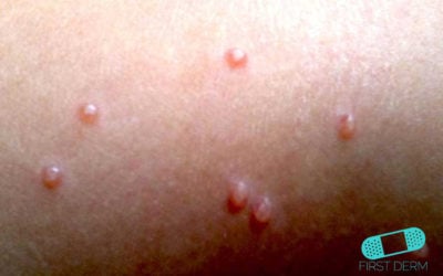 Molluscum contagiosum (Water warts)