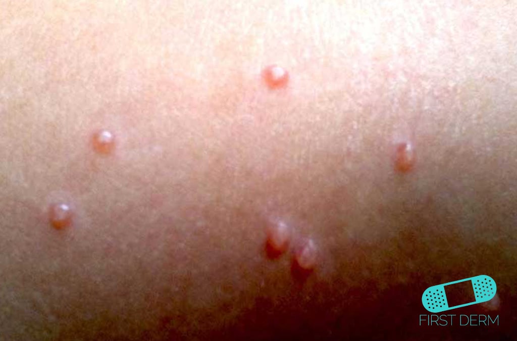 Guía de la piel - Molusco Contagioso