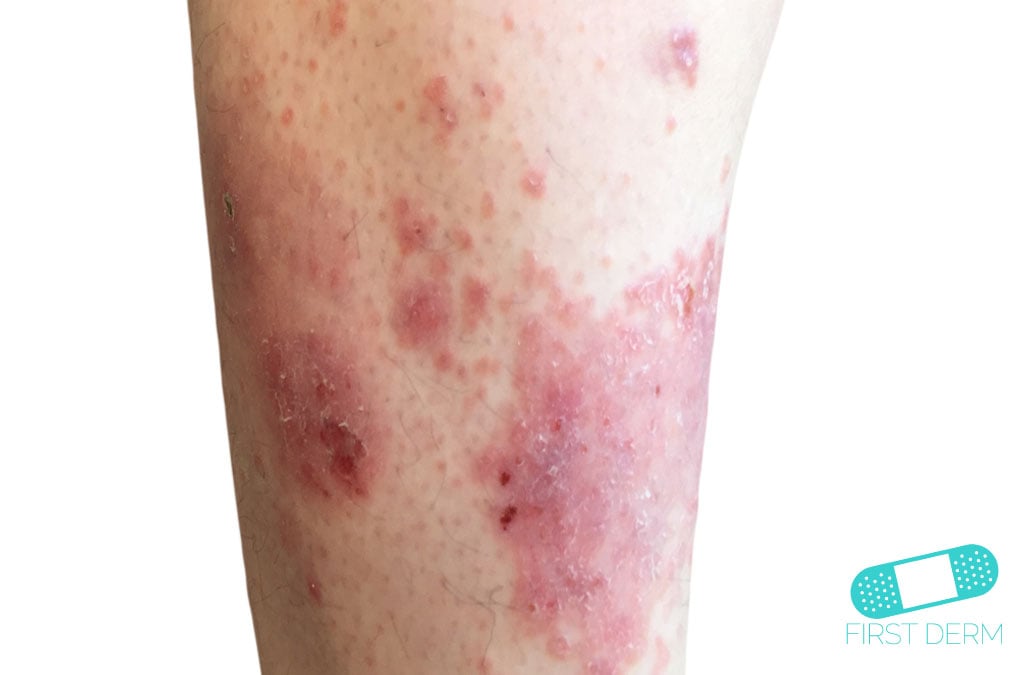 Varicose eczema - NHS Choices