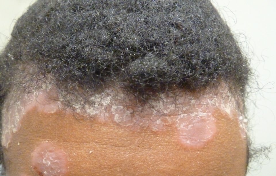 Syphilis Rashes On Back Syphilis - Online Dermatology