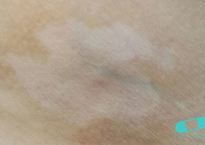 Vitiligo stomach (2) ICD-10-L80