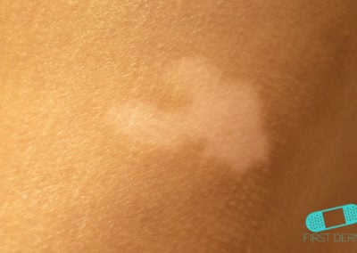 Vitiligo back (4) ICD-10-L80