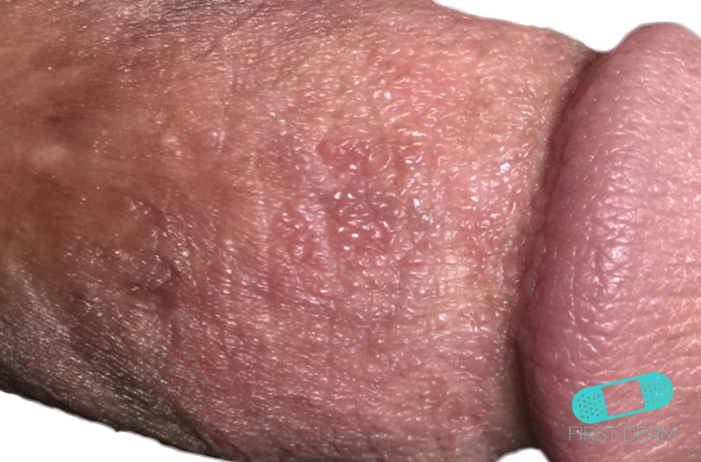 tiny bumps on skin #10