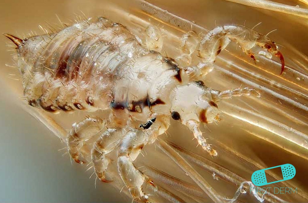 Head Lice Infestation