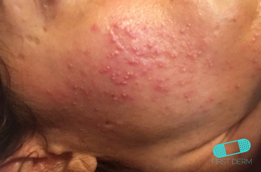 Rosacea – hudläkare på nätet
