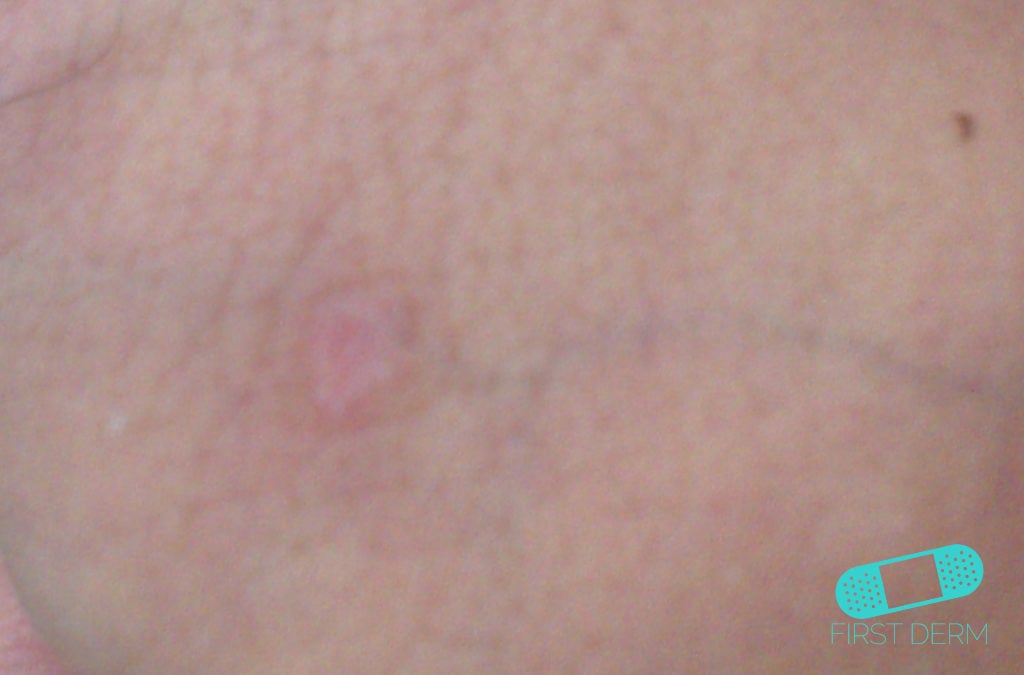 Syphilis