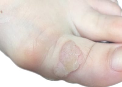 verruca vulgaris foot treatment