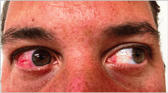 zika how fever to treat (Rash) Zika  Virus  Online Dermatology