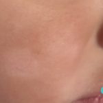 Guia De La Piel Milia Acne Del Bebe
