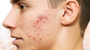 How to Deal with Acne: 5 Care and Prevention Tips