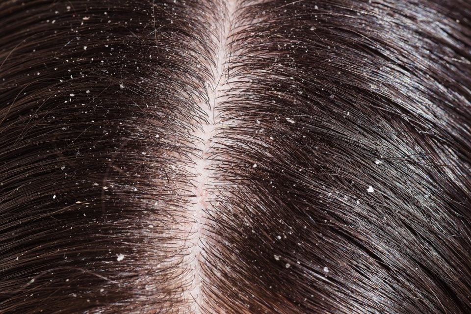 Hair Care 5 ways to Deal with Dandruff
