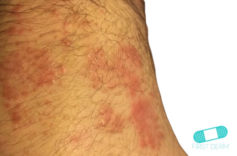 Itchy Red Bumps On Skin Potential Causes And Treatment